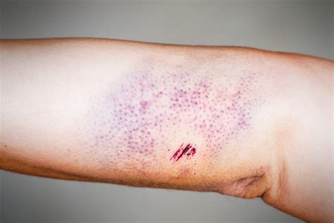 ematomi improvvisi sulle gambe